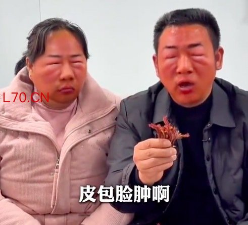 吃野菜的第一批受害者出现了 脸肿得像被一窝蜜蜂蛰过 亲妈都难认!